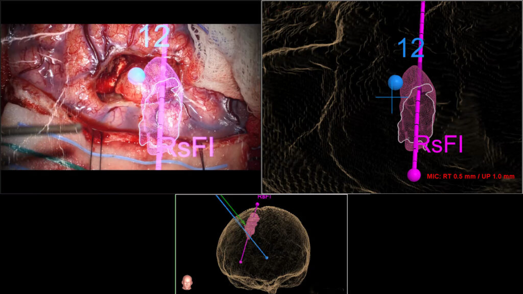 BrainSTORM Implement